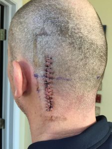 Dave's head wound right after he came home from the hospital. 14 staples!